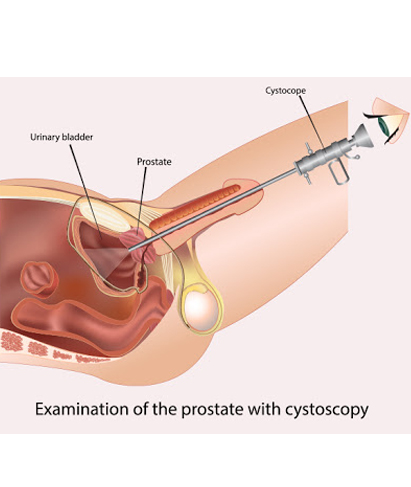 Optical Internal Urethrotomy