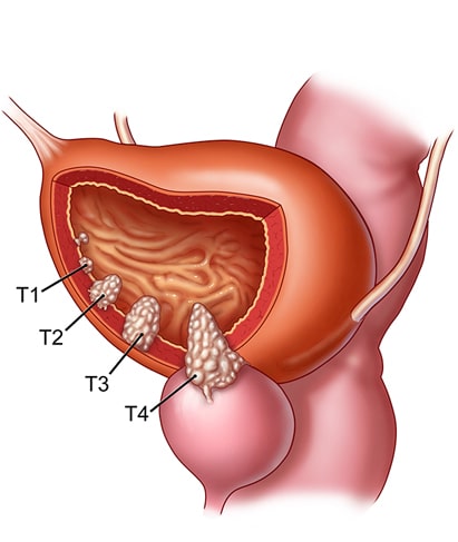 bladder-cancer